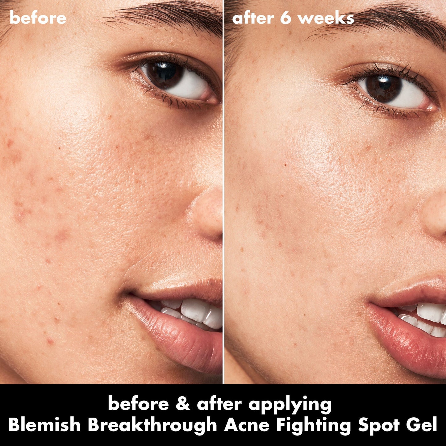 blemish-breakthrough-acne-fighting-spot-gel-m4 0326_EDU_BB_SpotGel_BA_ISABELLA.jpg