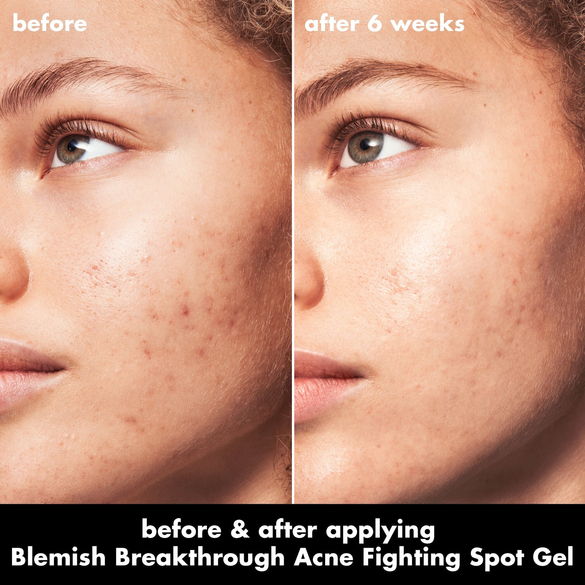blemish-breakthrough-acne-fighting-spot-gel-m4 0326_EDU_BB_SpotGel_BA_MARLEY.jpg