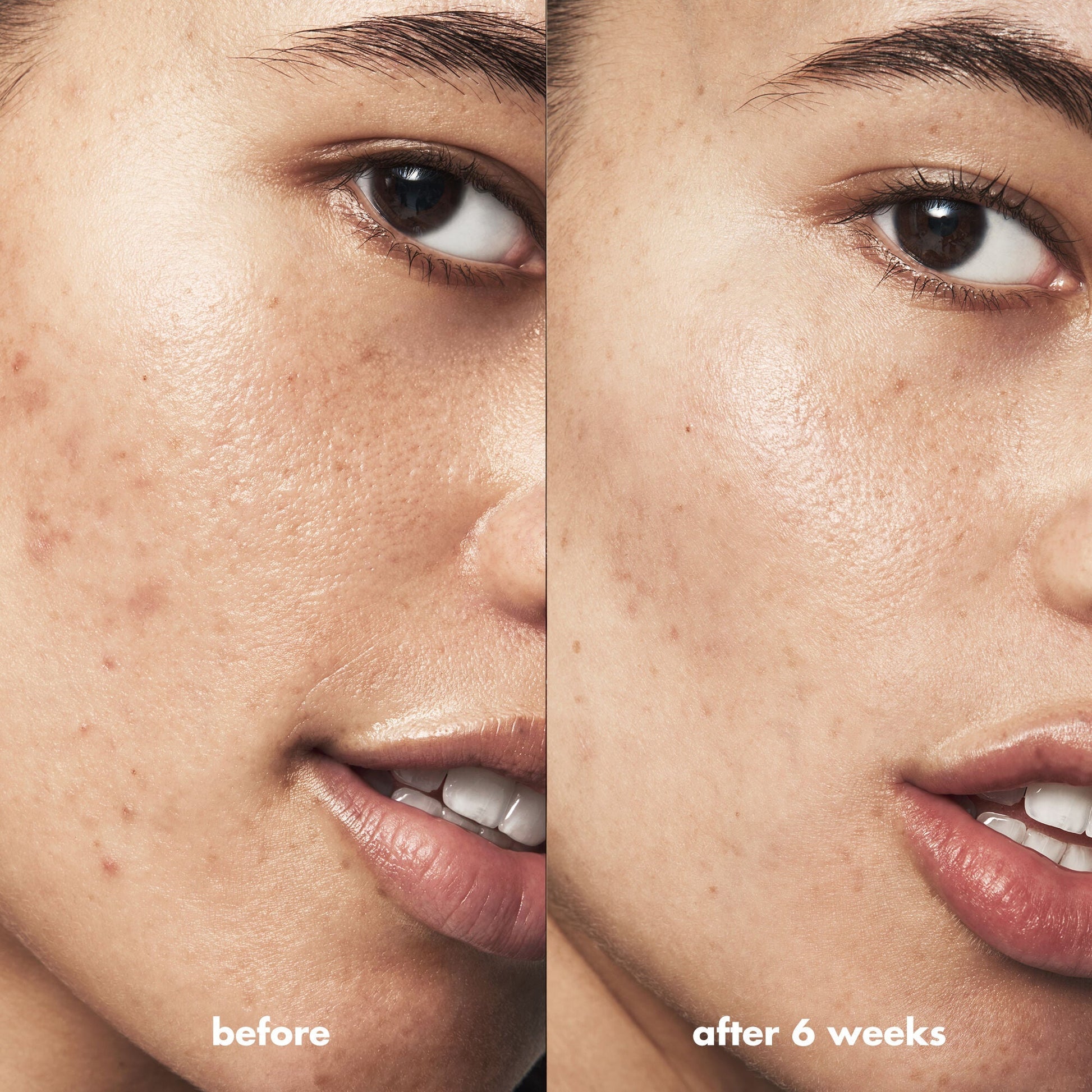 blemish-breakthrough-acne-calming-water-cream-mini-c6 Acne_PDP_Isabella_Before_After_f0d452cd-72f5-4bb8-a6df-0b3cc23143ef.jpg