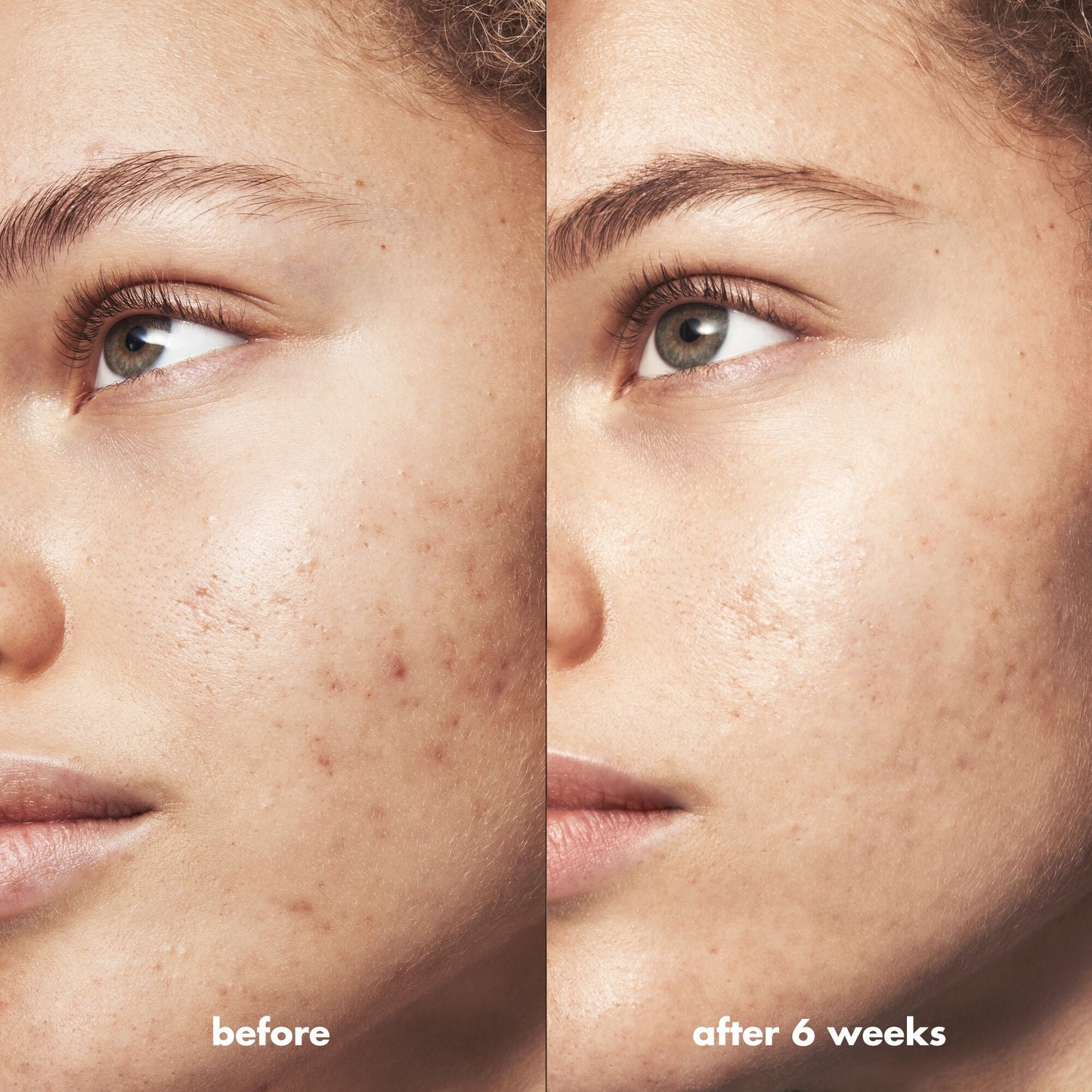 blemish-breakthrough-blemish-control-basics-kit-v9 Acne_PDP_Marley_Before_After_295728d2-6728-4f48-b8ef-c82bbca5b591.jpg